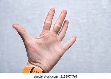 Hands With Corn Callus. Close-up Of Hands Damaged From Manual Labor. Cracked Skin On The Hand