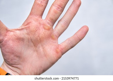 Hands With Corn Callus. Close-up Of Hands Damaged From Manual Labor. Cracked Skin On The Hand