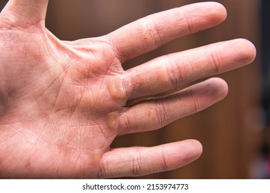 Hands With Corn Callus. Close-up Of Hands Damaged From Manual Labor. Cracked Skin On The Hand