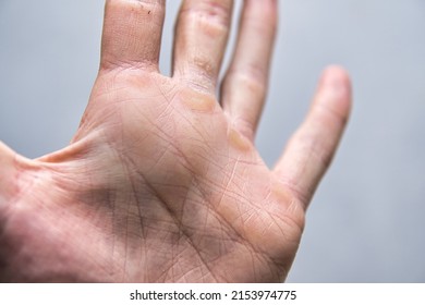 Hands With Corn Callus. Close-up Of Hands Damaged From Manual Labor. Cracked Skin On The Hand