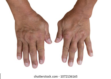 What Is Gout In Hands