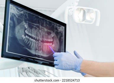 Hands doctor dentist in gloves show the teeth on x-ray on digital screen in dental clinic on light background with medical equipment. Smile healthy teeth concept, close up - Powered by Shutterstock