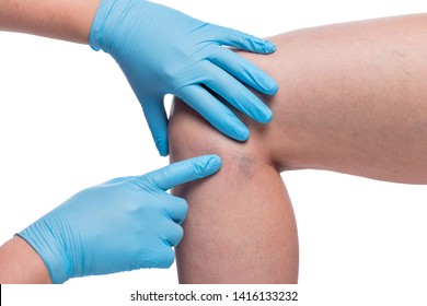 hands of doctor examine varicose veins on female leg, vessels close up