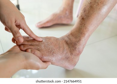 Hands of doctor or nurse examining the dry,cracked,swollen feet of old elderly people,skin care problems,senior woman with diabetes or kidney disease causing swollen legs,health care,medical concept - Shutterstock ID 2147664951