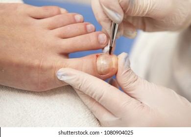 The Hands Of The Doctor Repair Broken Nails On The Female Legs