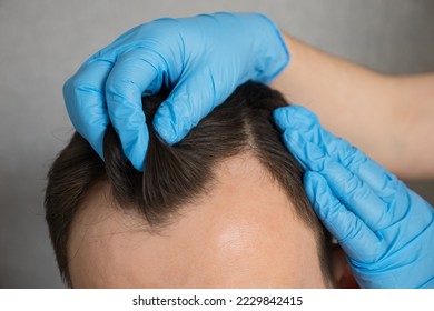 Hands of doctor in rubber gloves doing checkup of hair of man to fight male-pattern baldness. Patient gets prepared for hair transplant surgery closeup - Shutterstock ID 2229842415