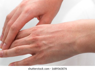 Hands With Dry, Irritated, And Cracked Skin