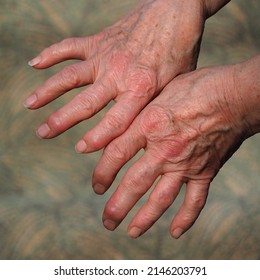 The Hands Of An Elderly Lady Experiencing Severe Arthritic Rheumatic Pains. Close-up Of An Elderly Woman's Hands. Hands Affected By Arthritis Of The Joints On The Fingers And Wrinkled Skin.