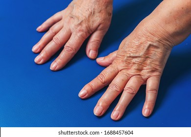 Old Hand Arm Large Bulging Veins Stock Photo (Edit Now) 1336302308