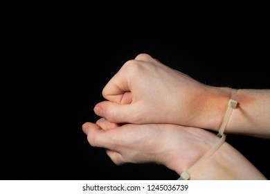 Hands In Handcuffs, Plastic Zip Tie On A Black Background. Big Bruise And Restriction Of Freedom. 