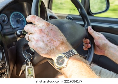 The Hands Of A Man With Vitiligo In Close-up On The Steering Wheel Control The Car. Pigmentation Disorder. Lifestyle.