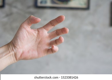 The Hands Of Patients With Spasticity