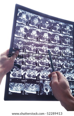 Hands with pen pointing out something on MRI scan.