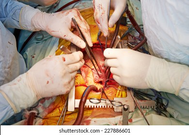 Hands Of Surgeons In Uniform Perform Heart Transplantation Operation On A Patient At Cardiac Surgery Clinic