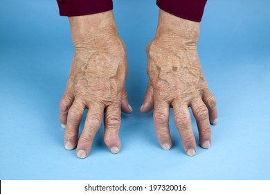 Hands Woman Deformed Rheumatoid Arthritis Stock Photo (Edit Now) 197320016