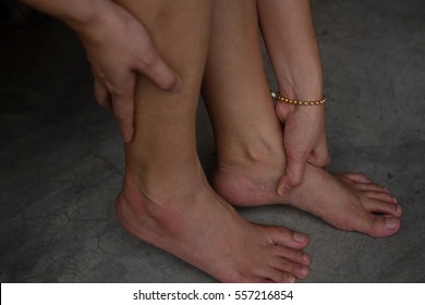 Hands of woman  touch clean red  foot that swelling /Bruises  / footsore/foot in pain/ injured foot / massaging foot / Bruises on foot 