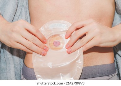 Hands of a young caucasian male sticking a colostomy bag to an adhesive circle around a the small intestine sticking out on his stomach,  top view. The concept of a step-by-step replacement of a bedbu