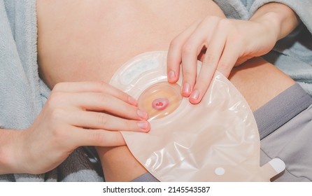 Hands of a young caucasian male sticking a colostomy bag to an adhesive circle around a the small intestine sticking out on his stomach,  top view. The concept of a step-by-step replacement of a bedbu