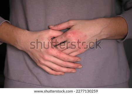 The hands of a young woman are covered with red blisters, blisters and scaly scales. Inflamed skin lesions on the outer side of the woman's hands itch and cause discomfort