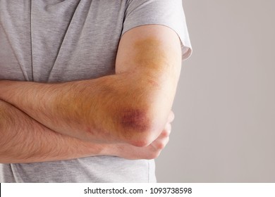 Handsome Man With Big Bruise On Forearm, Elbow And Arm.  Sport Injury.