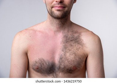 Handsome Man With A Lot Of Black Hair On One Side Of The Chest And Another Part Of The Breast After Waxing