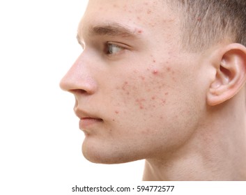 Handsome Young Man With Problem Skin On White Background