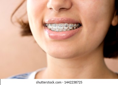 Happy smile of young woman with dental braces