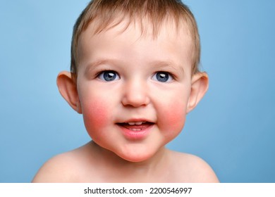 Happy Toddler Baby With Allergies On Her Face, Blue Studio Background. Portrait Of A Smiling Allergic Child With Red Cheeks. Kid Age One Year