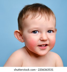 Happy Toddler Baby With Allergies On Her Face, Blue Studio Background. Portrait Of A Smiling Allergic Child With Red Cheeks. Kid Age One Year