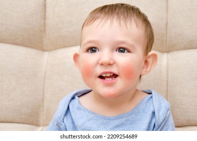 Happy Toddler Baby With Allergies On The Face, Sofa In The Home Living Room. Portrait Of A Smiling Allergic Child With Red Cheeks. Kid Age One Year And Two Months