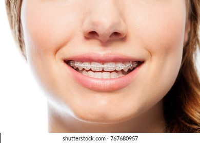 Happy Woman's Smile With Orthodontic Clear Braces