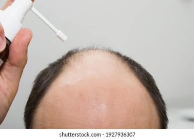 The head of a bald man using a hair growth remedy. Androgenetic alopecia.
