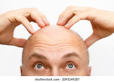 The head of a balding man. A bald man was upset because of the hair loss. Treatment of baldness.