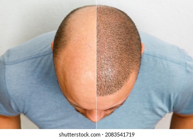 The head of a balding man before and after hair transplant surgery. A man losing his hair has become shaggy. An advertising poster for a hair transplant clinic. Treatment of baldness. - Shutterstock ID 2083541719