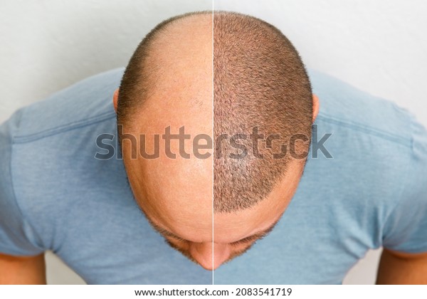 The head\
of a balding man before and after hair transplant surgery. A man\
losing his hair has become shaggy. An advertising poster for a hair\
transplant clinic. Treatment of\
baldness.
