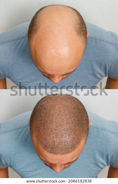 The head\
of a balding man before and after hair transplant surgery. A man\
losing his hair has become shaggy. An advertising poster for a hair\
transplant clinic. Treatment of\
baldness.