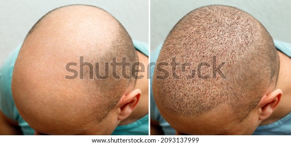 The head
of a balding man before and after hair transplant surgery. A man
losing his hair has become shaggy. An advertising poster for a hair
transplant clinic. Treatment of
baldness.