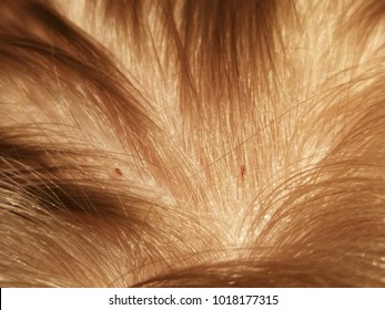 Head Lice Comb Images Stock Photos Vectors Shutterstock