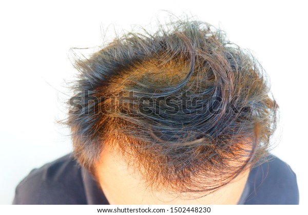 Head Middleaged Asian Man Who Losing Stock Photo Edit Now 1502448230
