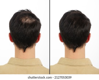 Head seen from behind showing the nape of a young man with calvization principle before and after anti-hair loss treatment. Concept of early hair loss
