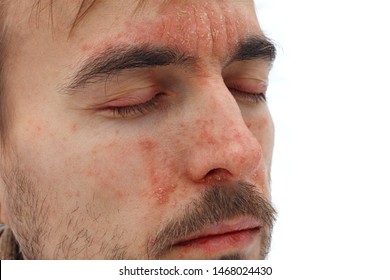 Head Of Sick Man With Closed Eyes With Red Allergic Reaction On Facial Skin, Redness And Peeling Psoriasis On Nose, Forehead And Cheeks, Seasonal Skin Problem, Side View, White Background