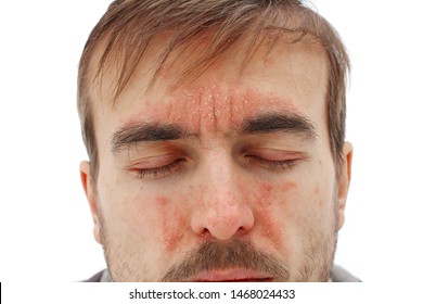 Head Of Sick Man With Closed Eyes With Red Allergic Reaction On Facial Skin, Redness And Peeling Psoriasis On Nose, Forehead And Cheeks, Seasonal Skin Problem, White Background