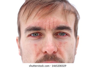 4,221 Face allergic reaction Images, Stock Photos & Vectors | Shutterstock