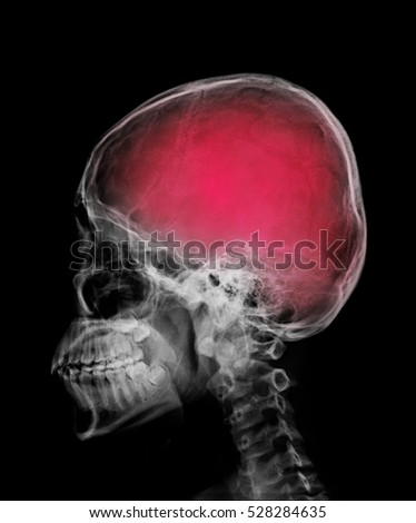 head skull x-ray side view and area of brain show in red color
