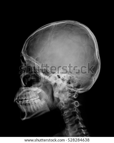 head skull x-ray side view 