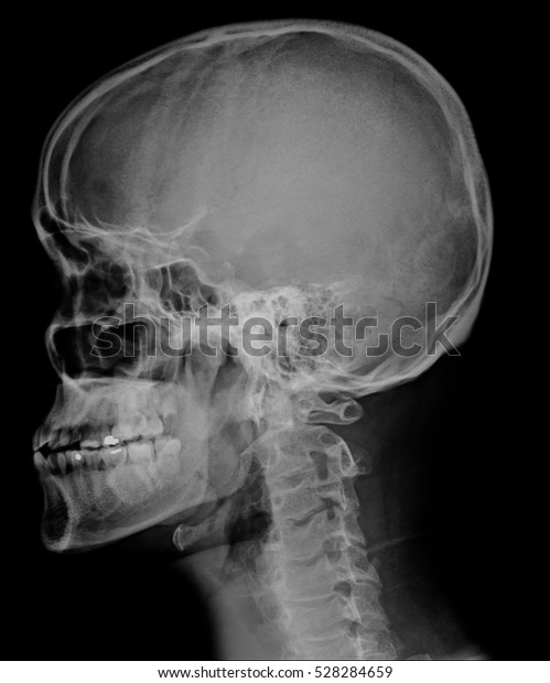 head skull x-ray side view