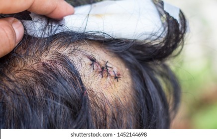 Craniotomy Images, Stock Photos & Vectors | Shutterstock