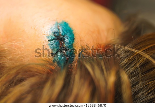 Head wound after a car accident.
Brilliant green solution on the forehead. Head injury. Wound
treatment with a disinfectant. Stitching on the
scalp.