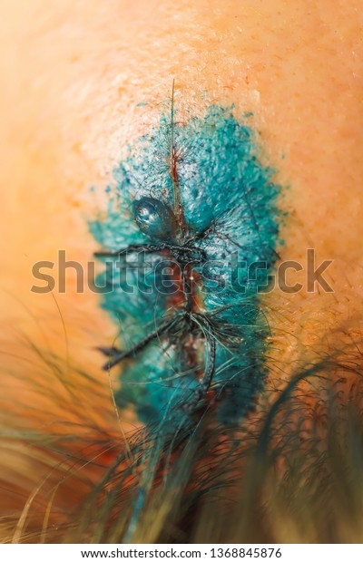 Head wound after a car accident.\
Brilliant green solution on the forehead. Head injury. Wound\
treatment with a disinfectant. Stitching on the\
scalp.