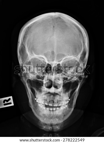 Head x-ray image.